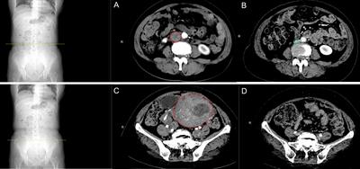 Intravenous metastasis of unexpected uterine sarcoma in the context of uterine fibroids: case report and literature review